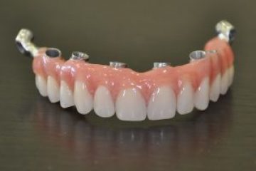 השתלות שיניים ביום אחד יתרונות וחסרונות